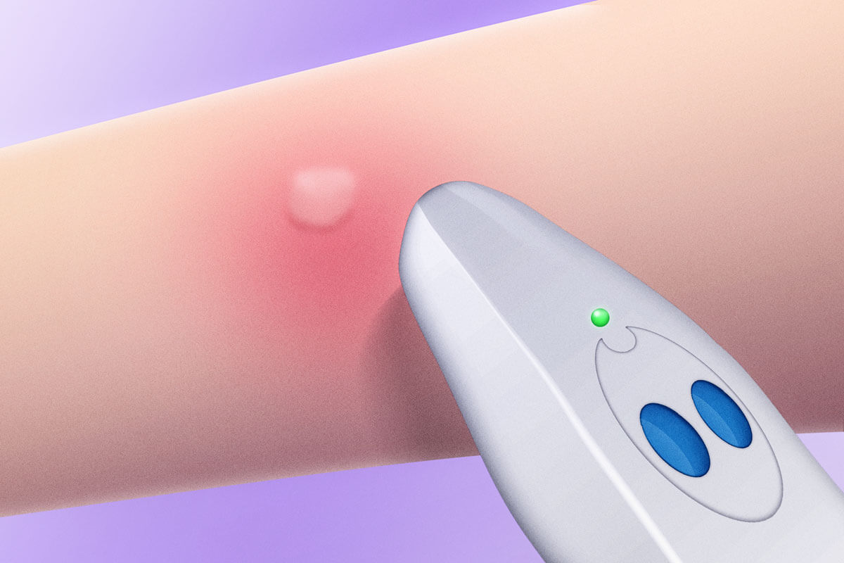 insect bite healer review & comparison 2022 FinalCheck