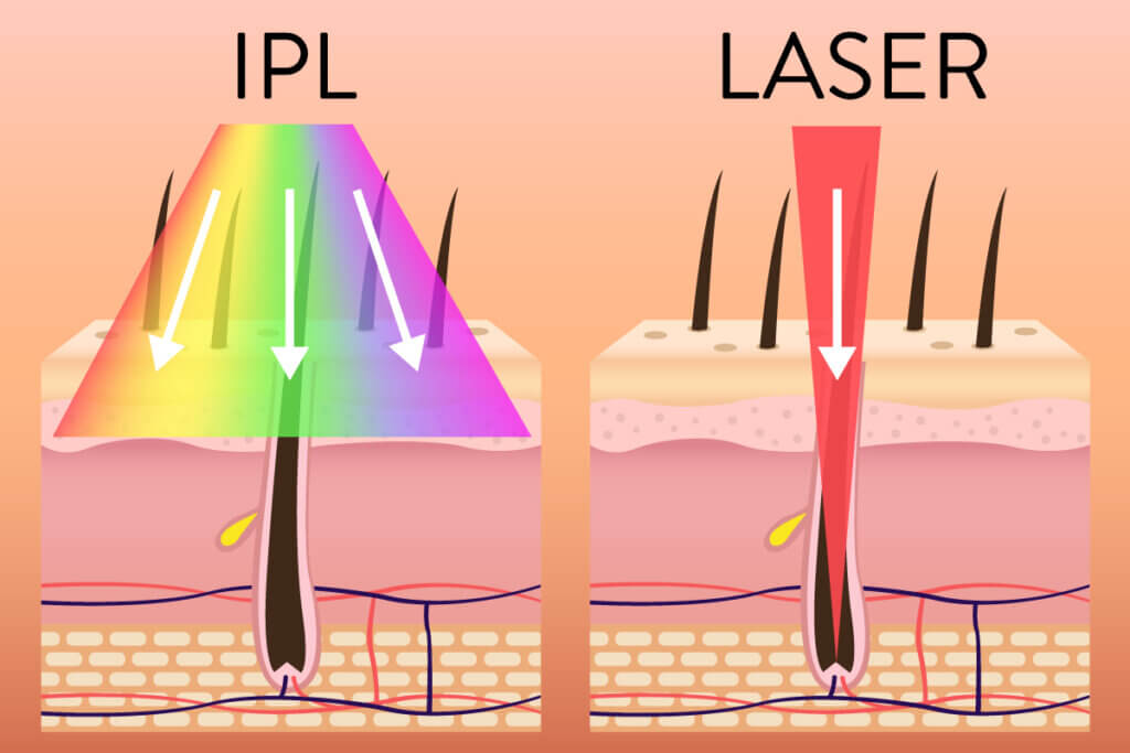 Difference between IPL and laser